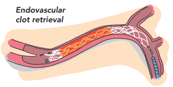 Endovascular clot retrieval, with a stent inserted into an artery to pull out a clot